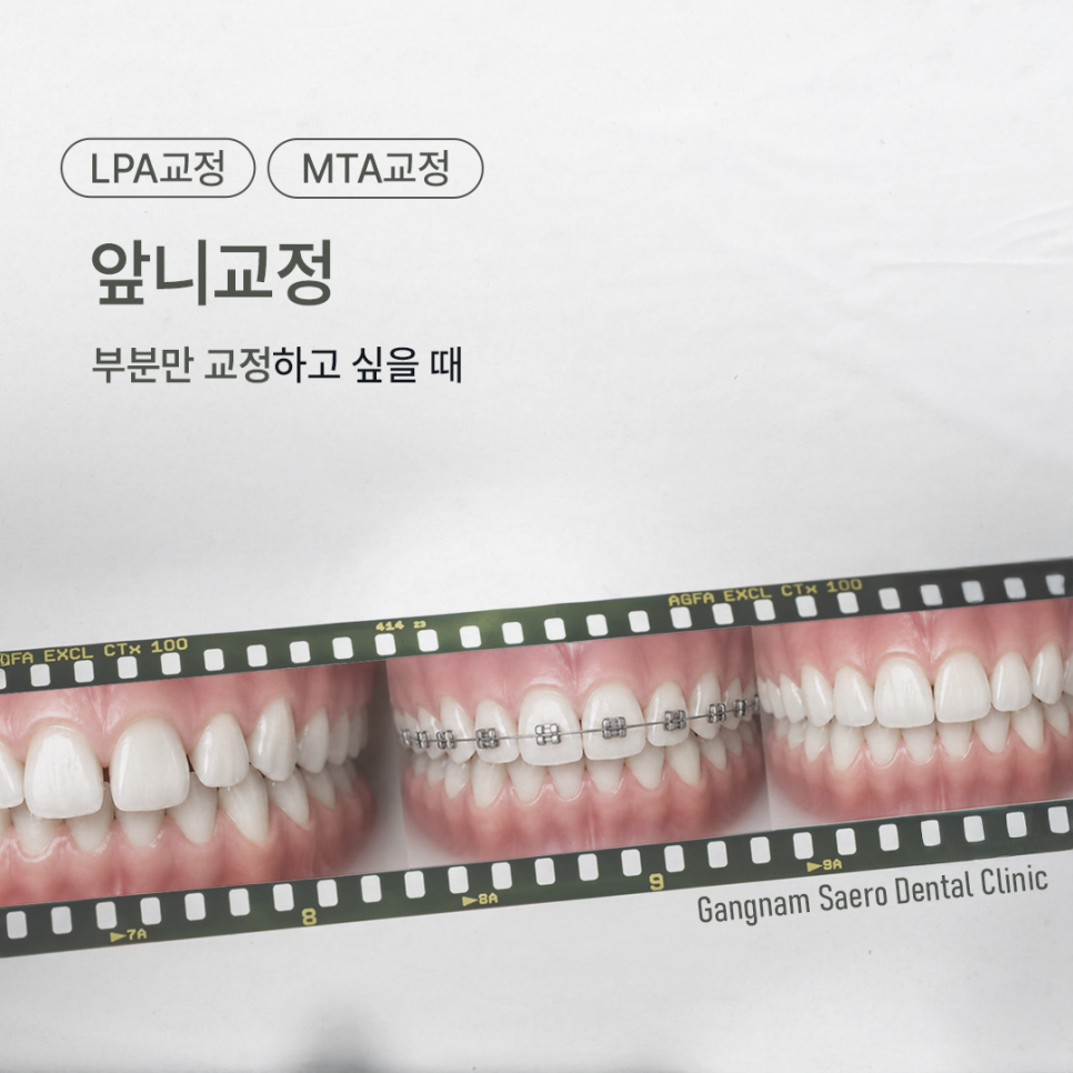 앞니만 교정하고 싶다면 부분만 교정하는 (앞니교정) 관련 이미지 1