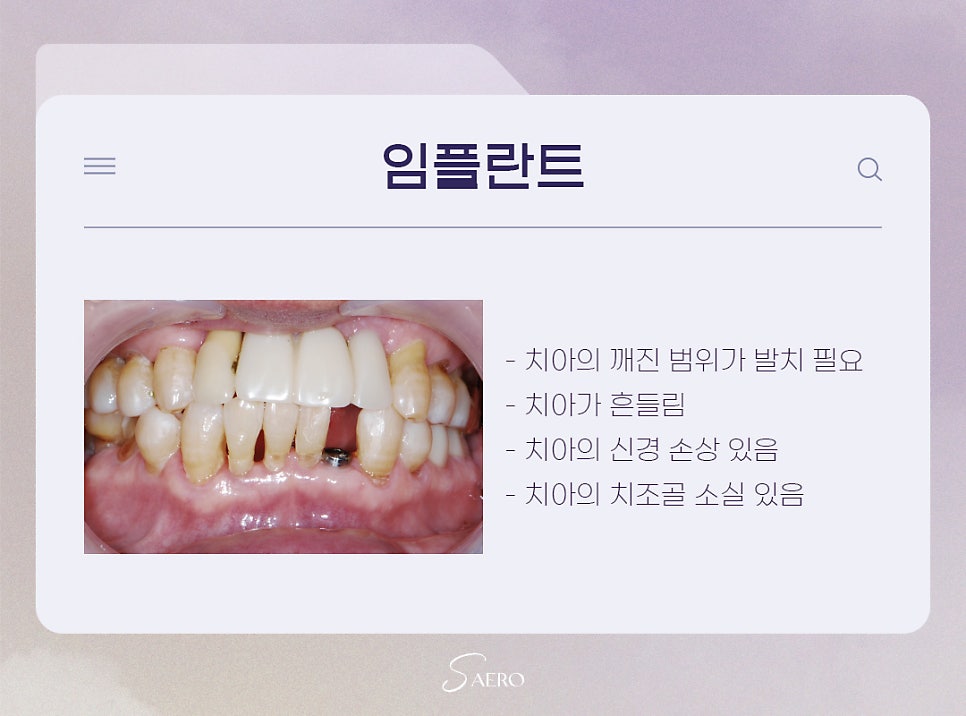 앞니 손상 시 치료 방법 (앞니깨졌을때) 관련 이미지 7