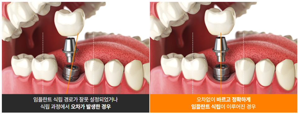 붓기, 출혈, 통증 최소화 임플란트 (네비게이션임플란트) 관련 이미지 1