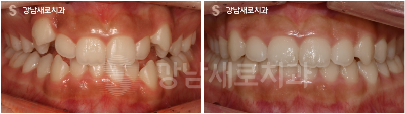 강남역교정치과를 찾고 계신다면? 비발치로 해결하세요! 관련 이미지 5