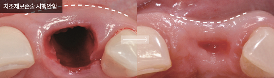 임플란트 부작용 자세히 알아보기(3) 임플란트 치주조직손상 부작용 [ 예방 및 대처 방법 ] [ 강남새로치과 ] 관련 이미지 5
