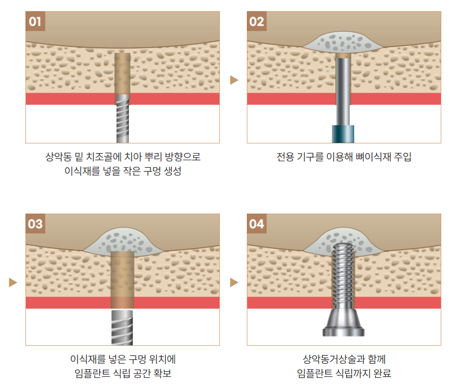 임플란트 안전한 결과를 위하여 [ 상악동거상술 ] [ 강남새로치과 ] 관련 이미지 5