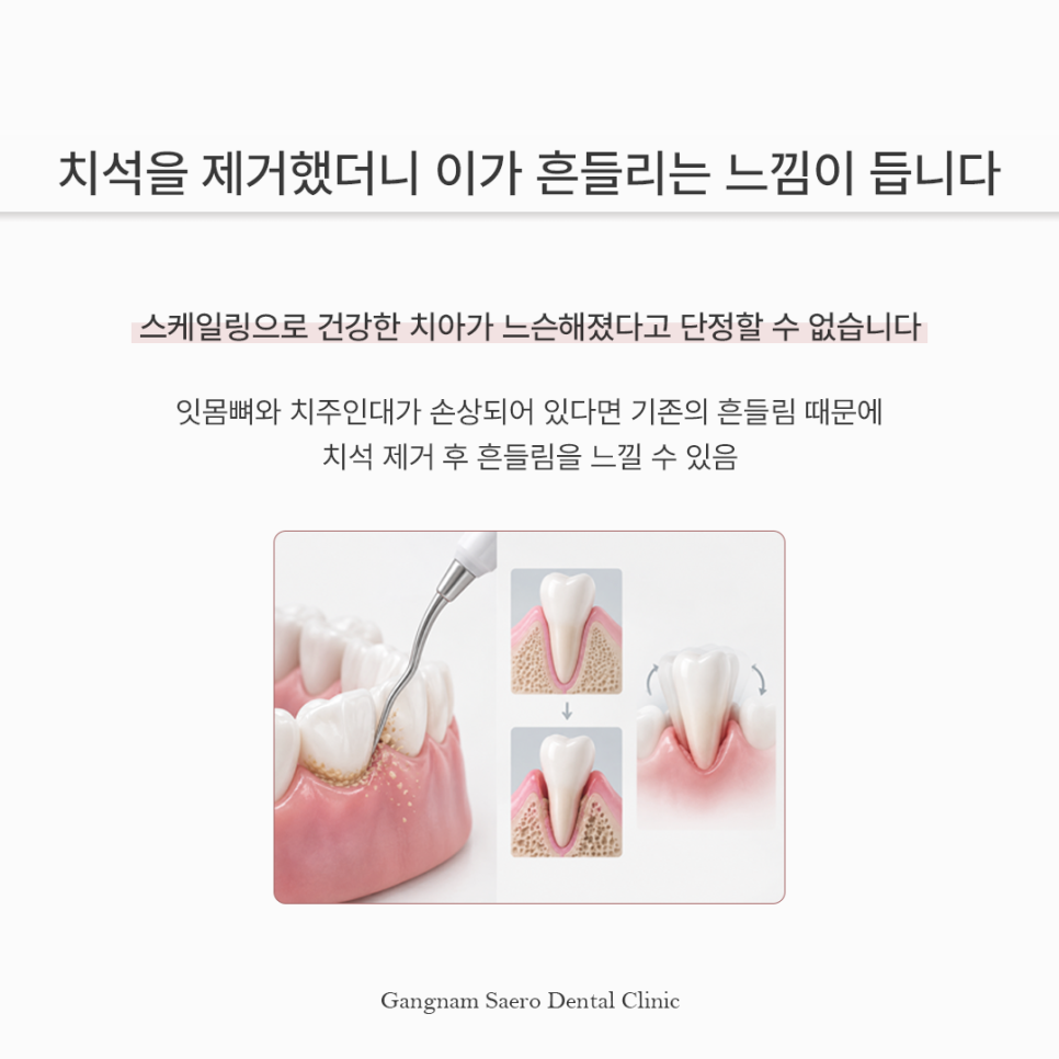 스케일링 후 이가 시리고 벌어졌다? 스케일링부작용 오해와 진실 관련 이미지 3
