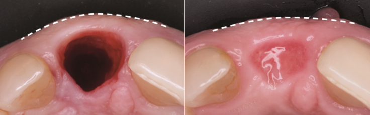 임플란트 안전한 결과를 위하여 [ 상악동거상술 ] [ 강남새로치과 ] 관련 이미지 10
