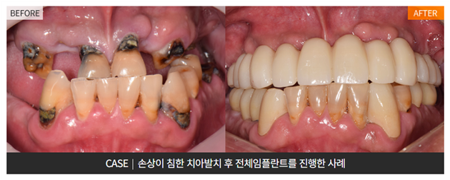 An Efficient Choice When Only a Few Teeth Remain (Full-Mouth Implant Effect) image 5
