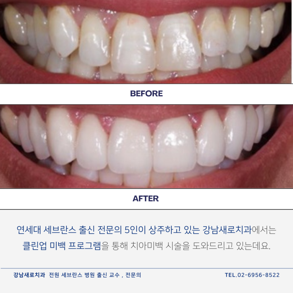 셀프치아미백제, 구매 전 반드시 확인해야 하는 관련 이미지 12