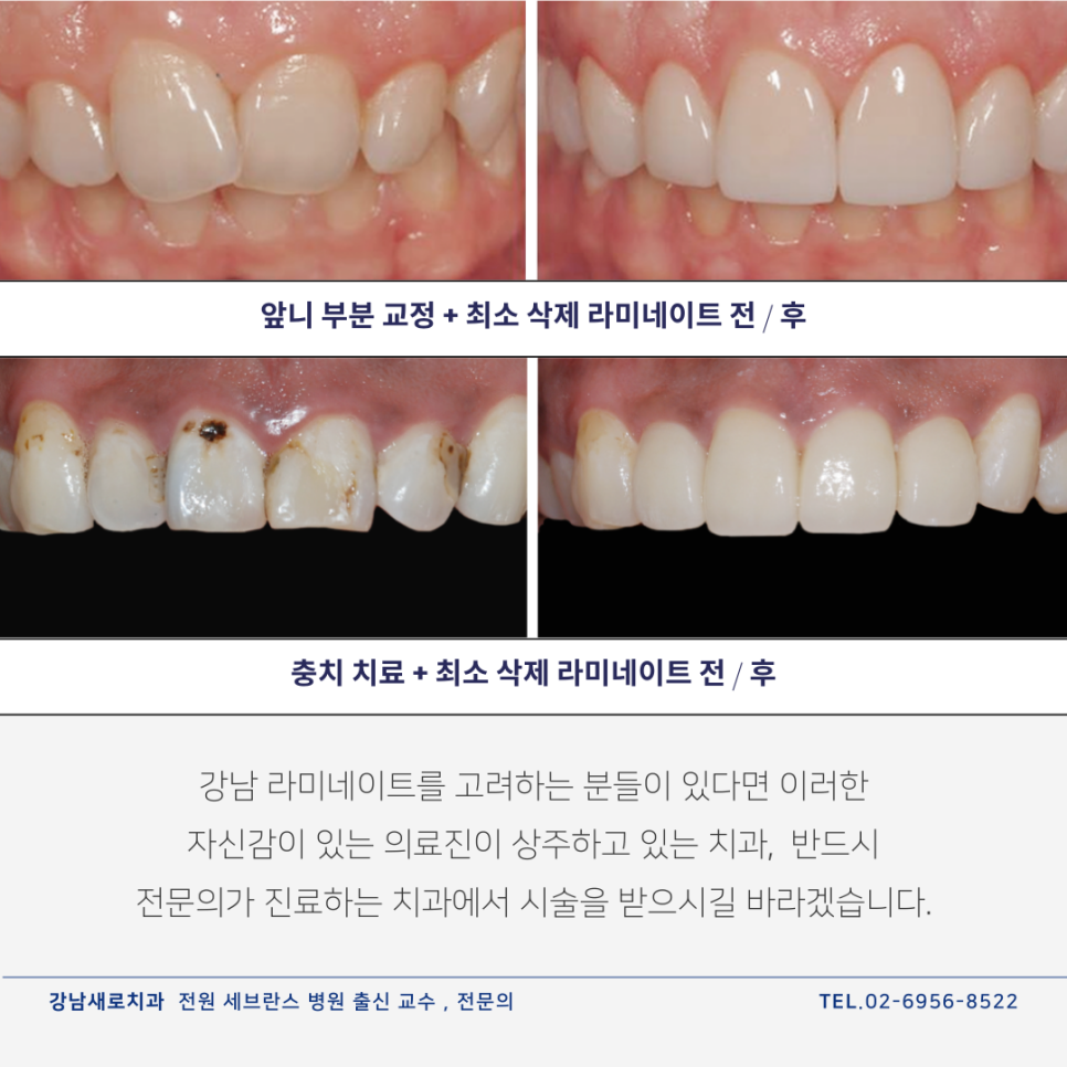 강남라미네이트, 무삭제가 최고? 전문의가 진실을 알려드립니다. 관련 이미지 11