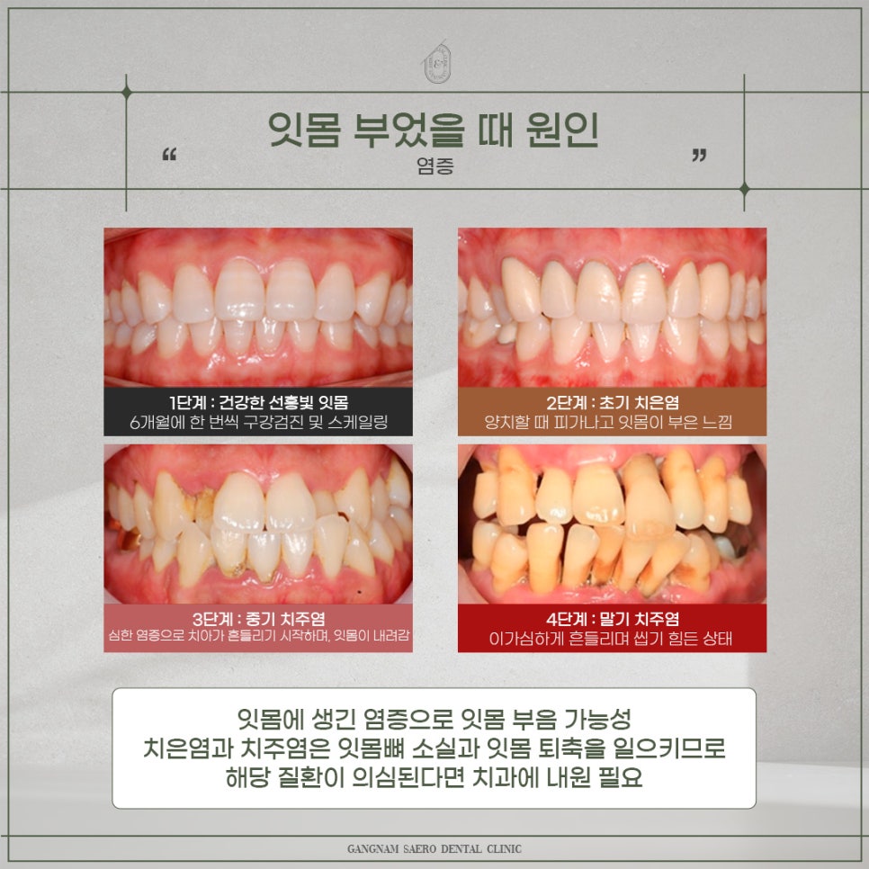 잇몸부었을때 예방법과 해결법 (잇몸염증) 관련 이미지 4