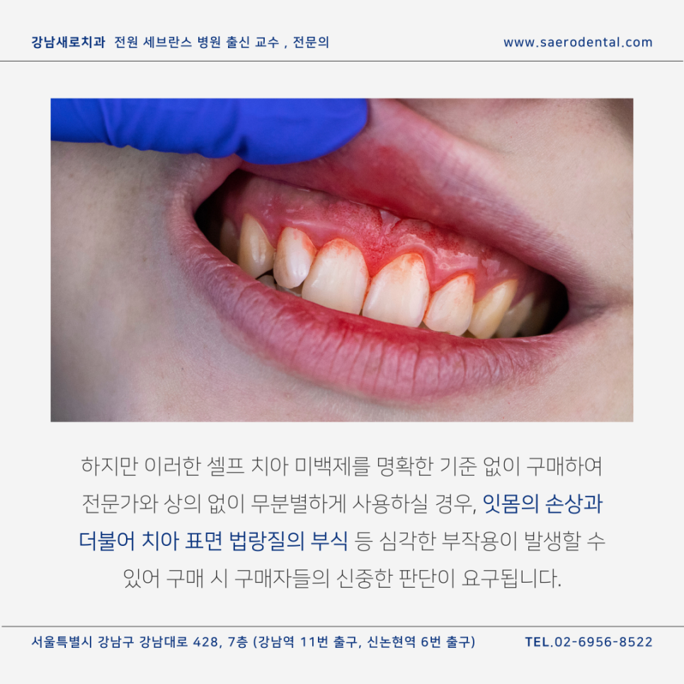 셀프치아미백제, 구매 전 반드시 확인해야 하는 관련 이미지 5