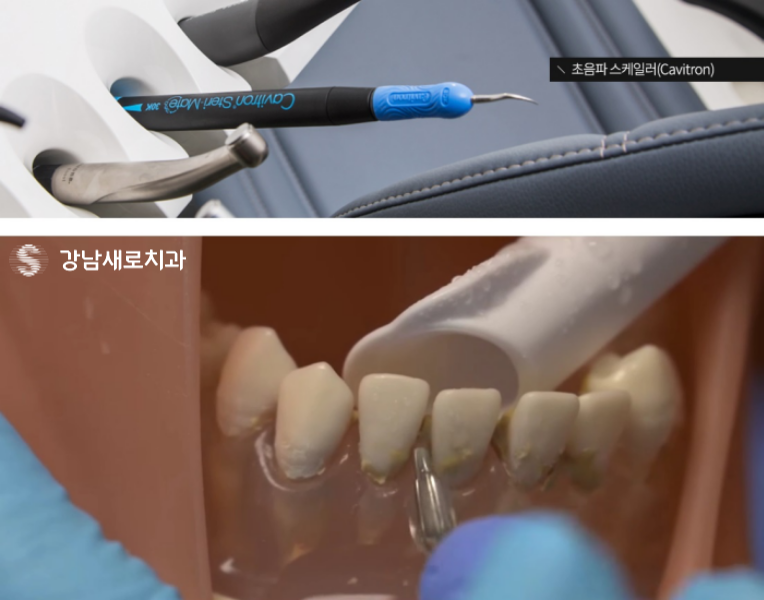 강남역잇몸염증치료, 잇몸피가 나는 원인의 치료방법? 관련 이미지 5