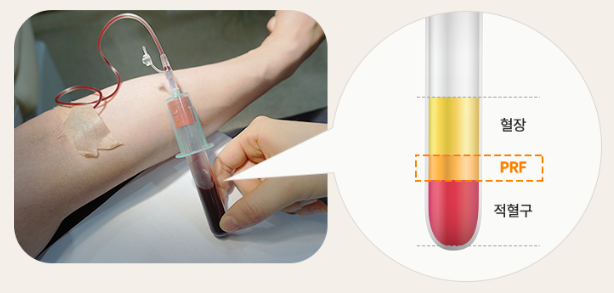 최소식립 65세 70대 임플란트 (전체임플란트) 관련 이미지 4