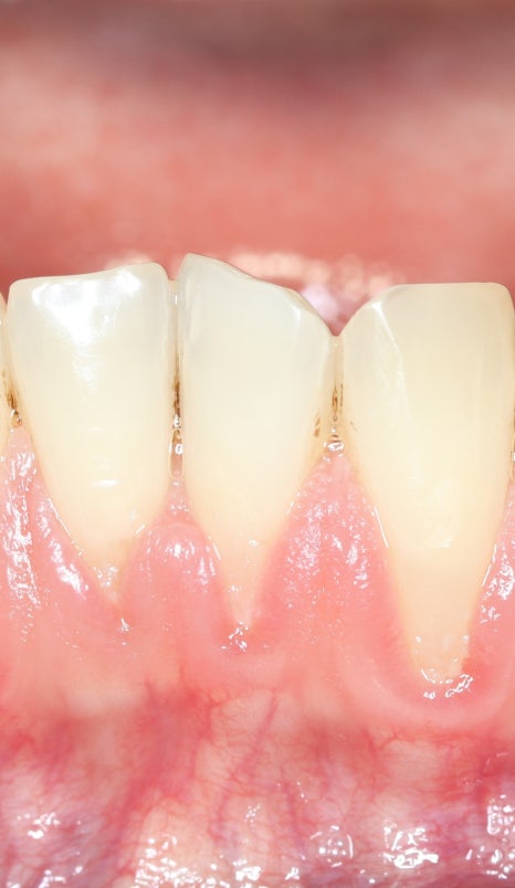 구강질환을 예방하는 치주질환치료 관련 이미지 2