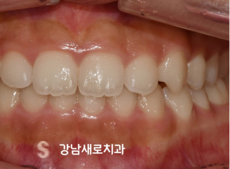 비발치교정 치료, 발치 없이 진행하는 과정 관련 이미지 10