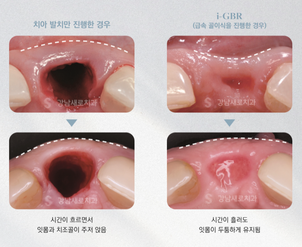 전체를 보면 하나의 결과가 보인다, 강남새로치과 전체임플란트 관련 이미지 4