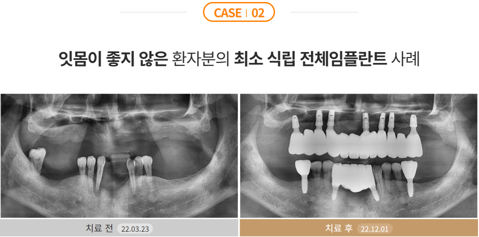 임플란트 잘하는 병원 (전체임플란트) 관련 이미지 4