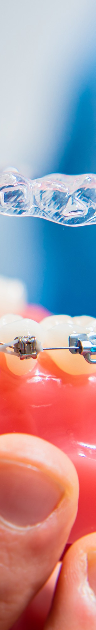 강남역치아교정, 비발치 치료, 구강 구조 개선, 맡길 수 있는 곳에! 관련 이미지 17