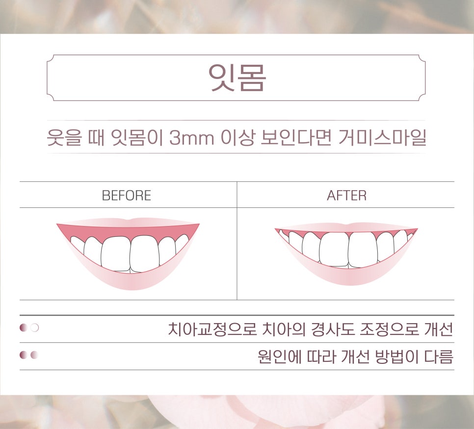 (부정교합 / 앞니 / 잇몸) 비수술 치과성형 관련 이미지 6