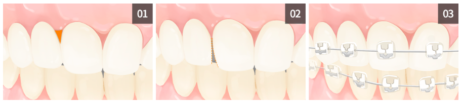 4개월 급속교정 (전체교정은 부담스럽다면 부분교정) [ 강남새로치과 ] 관련 이미지 8