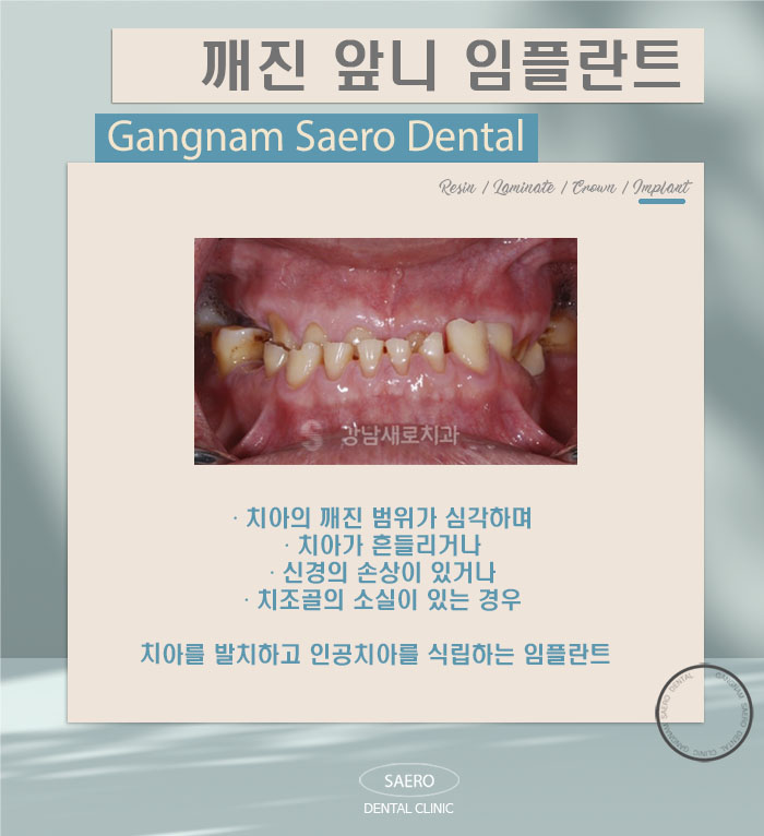 앞니가 깨졌어요! (깨진앞니 치료법) 관련 이미지 7