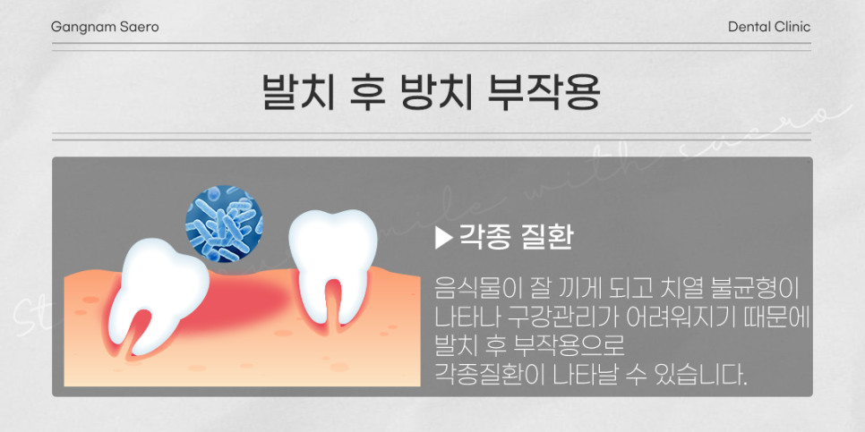 발치 후 꼭 임플란트 해야 하나요? (임플란트안하면) 관련 이미지 4