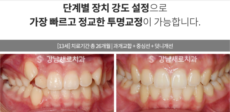 송곳니덧니교정, 방치하면 부작용이 발생한다? 관련 이미지 14