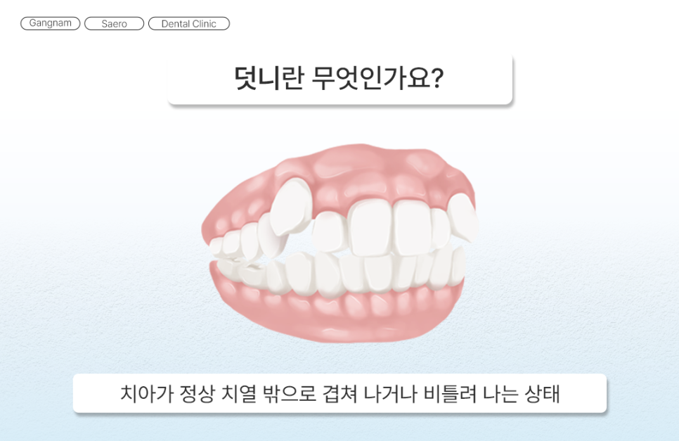 삐뚤어진 치아를 가지런하게 기능과 심미 회복 (덧니교정) 관련 이미지 2