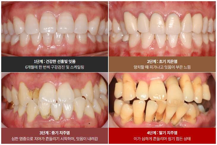 강남역근처치과 강남역스케일링 (무통스케일링) 관련 이미지 2