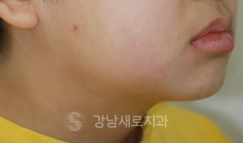 유아주걱턱교정, 더 효율적인 치료를 위해 성장기 전에 시작해야한다? 관련 이미지 2