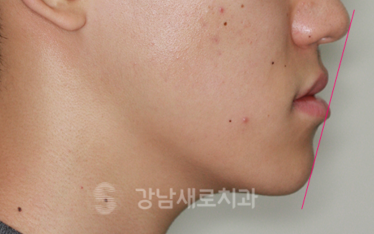 유아 주걱턱교정, 올바른 뼈 성장을 위한 방법 관련 이미지 6