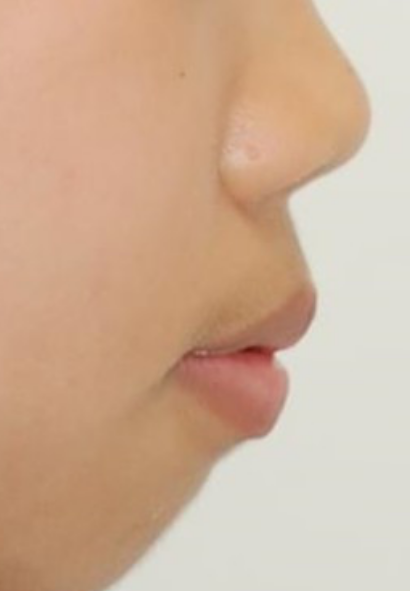 콤플렉스인 뻐드렁니 돌출입 교정으로 개선이 가능할까? 관련 이미지 2