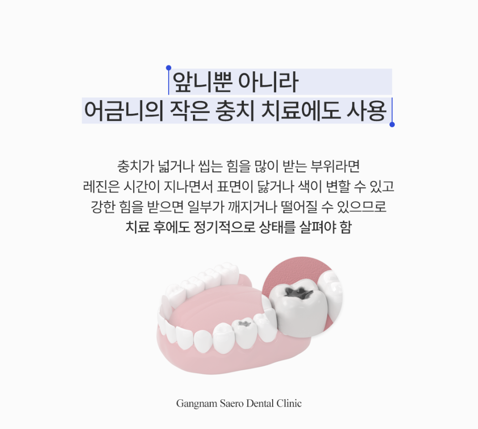 앞니가 깨지거나 벌어졌다면? 레진 치료 안내 관련 이미지 5