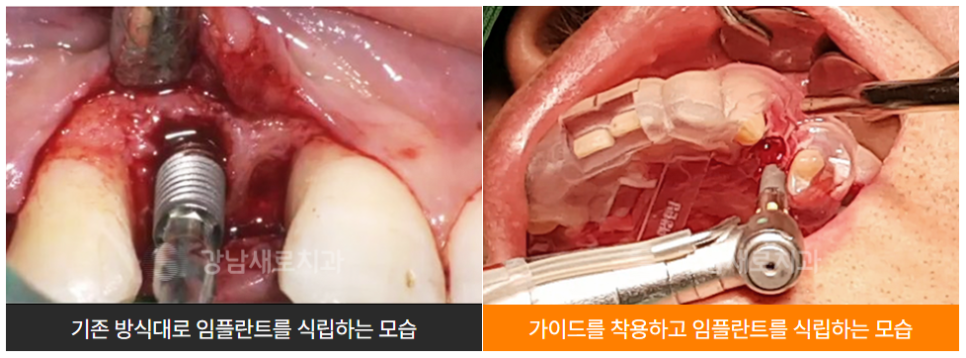 붓기, 출혈, 통증 최소화 임플란트 (네비게이션임플란트) 관련 이미지 3