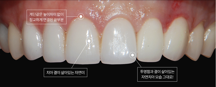 일주일만에 완성되는 최단기 치아성형 (에어네이트) 관련 이미지 7