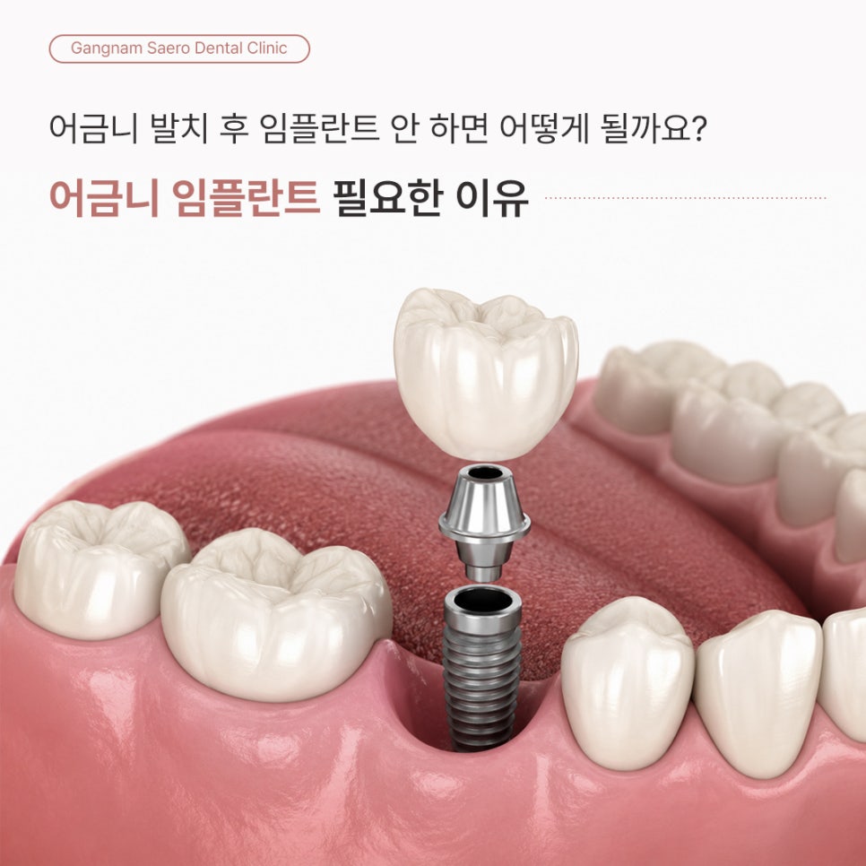 어금니 발치 후 임플란트 안 하면 어떻게 될까요? (어금니임플란트) 관련 이미지 1