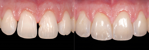 크랙 벌어짐 파절 치아깨짐치료 (레진이란?) 관련 이미지 4