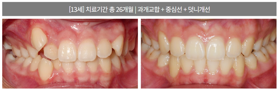 투명교정종류 자세히 알아보기 (2) 나노라이너 관련 이미지 3