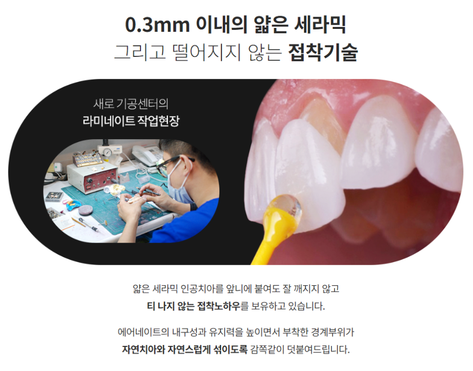 에어네이트의 특별함 (라미네이트 대체 시술) 관련 이미지 7