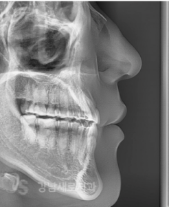 양악전 교정과 양악후 교정, 진행 방법의 차이를 알아보자. 관련 이미지 7