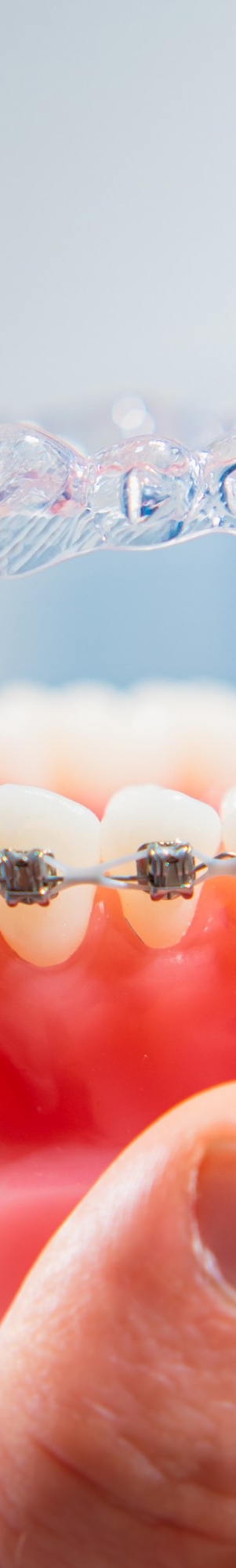 강남역치아교정, 비발치 치료, 구강 구조 개선, 맡길 수 있는 곳에! 관련 이미지 16