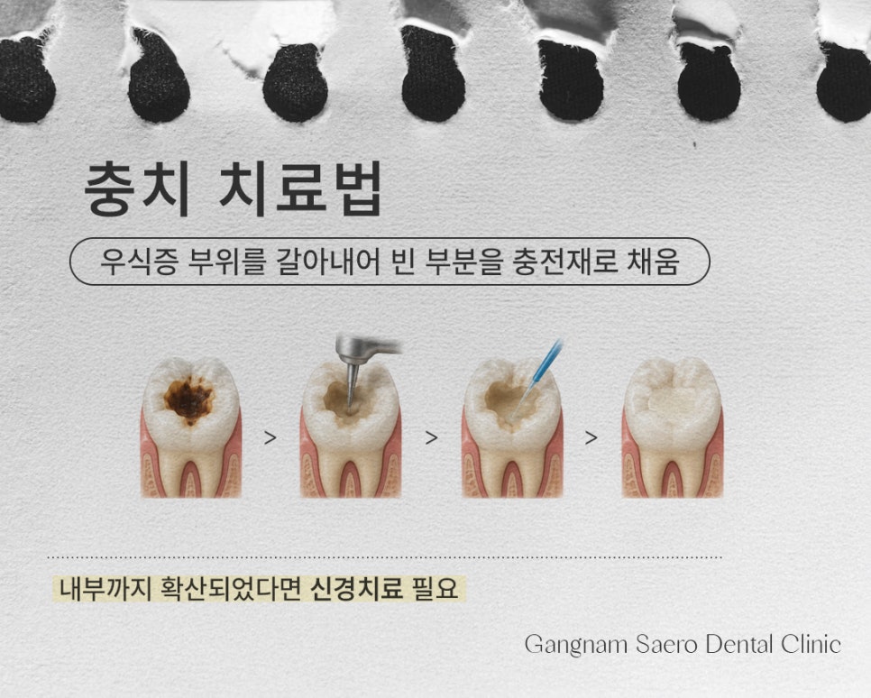 Types and Materials of Dental Caries Treatment by Stage (Types of Cavity Treatment) image 4