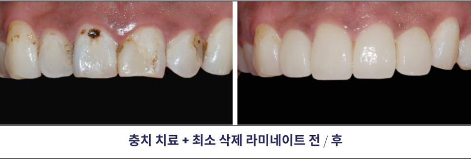강남역라미네이트, 부작용을 최소화하는 방법? 관련 이미지 11