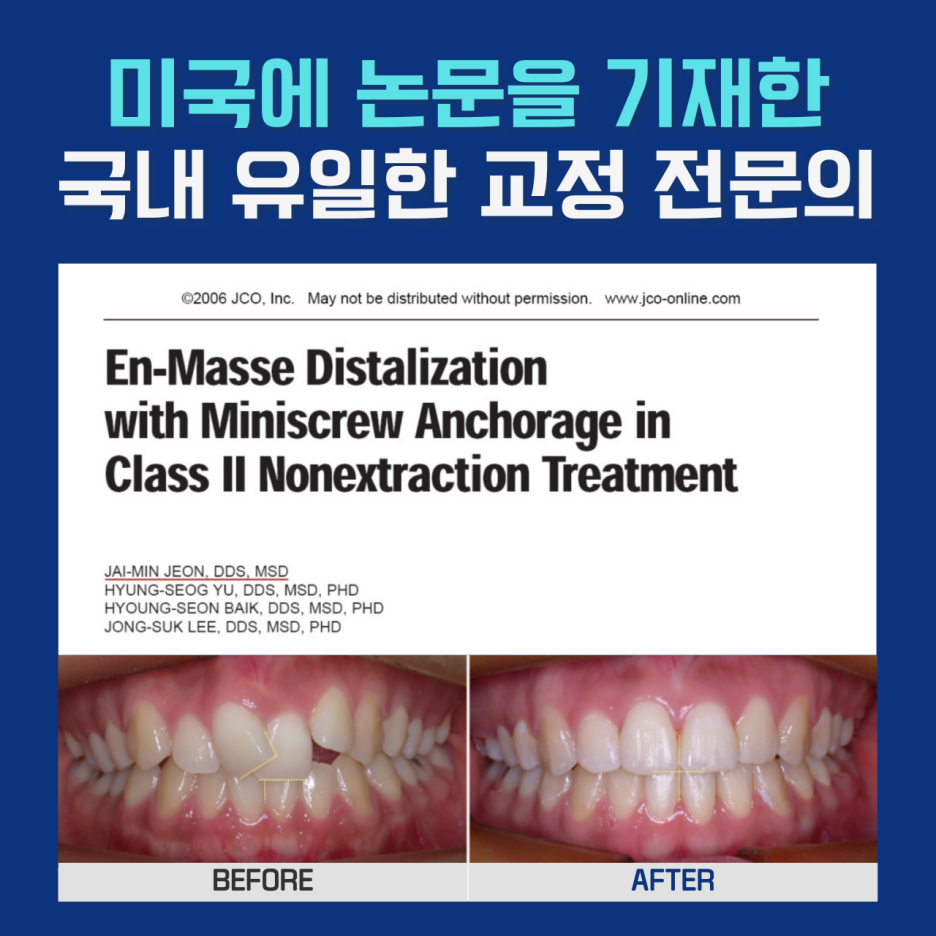 벌어진앞니 교정 치료, 발치 없이 진행하려면? 관련 이미지 1