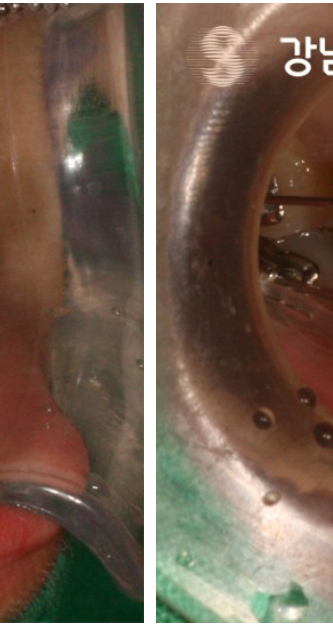 비발치교정 치료, 발치 없이 진행하는 과정 관련 이미지 3