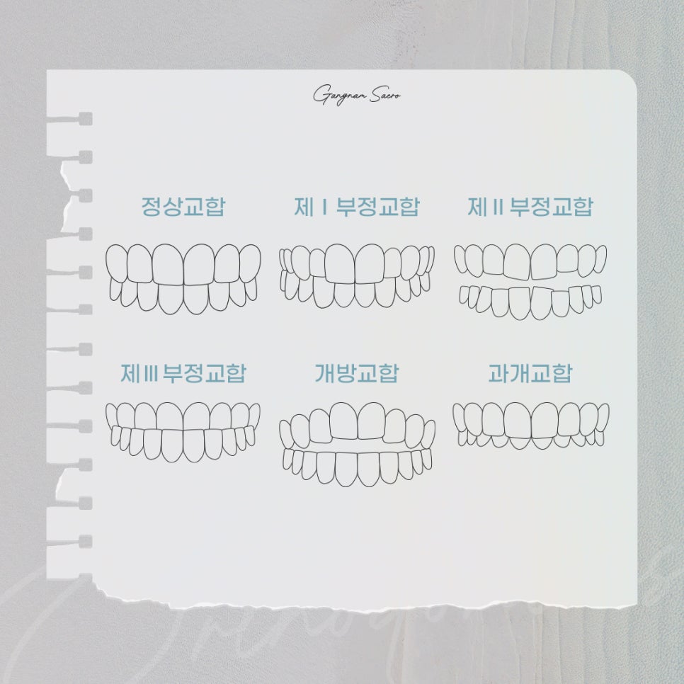비수술 부정교합을 위한 치과 교정 (투명교정부정교합) 관련 이미지 9