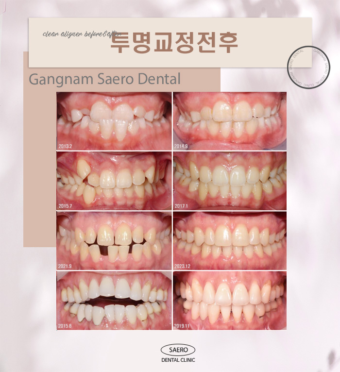 투명교정효과 안내 투명교정전후 효과 (투명교정후기) 관련 이미지 4