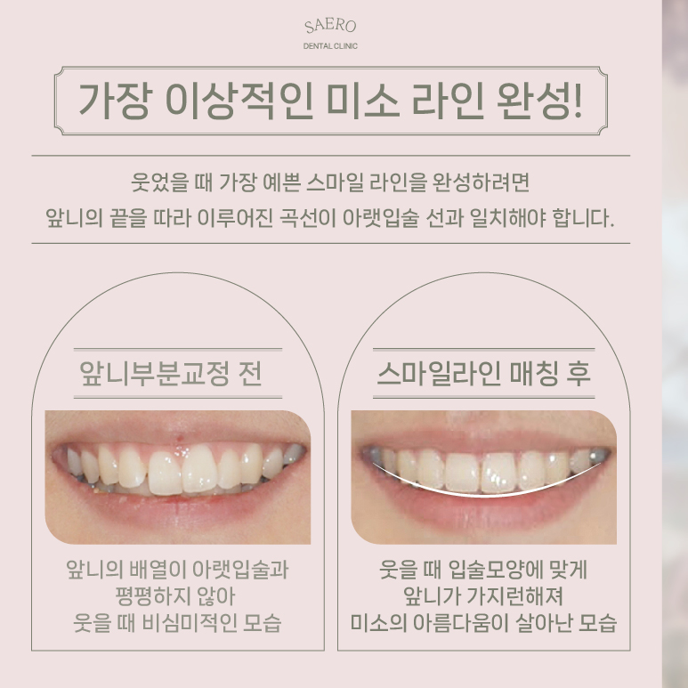 급속교정과 에어네이트로 완성하는 (최단기치아성형) 관련 이미지 5