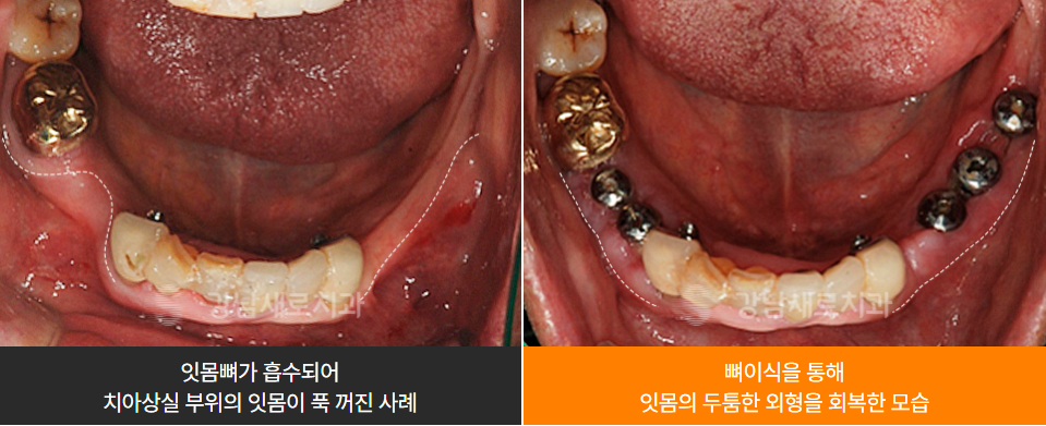 임플란트도 실패가 있습니다 (임플란트주의사항) 관련 이미지 8