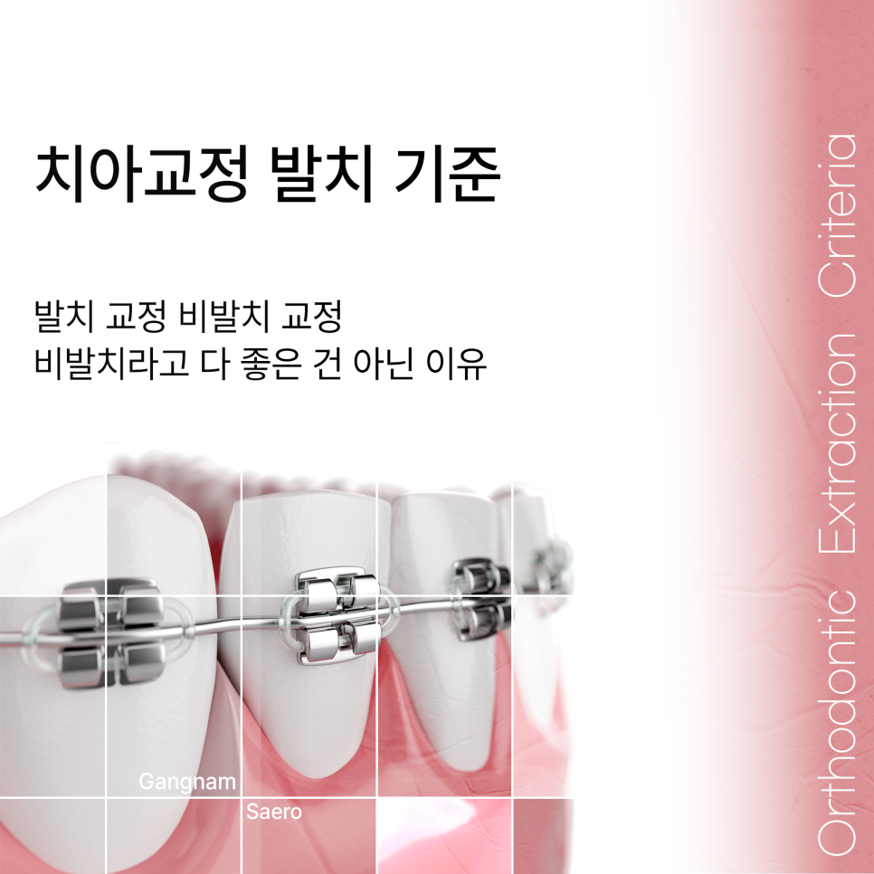비발치 교정이 다 좋지만은 않은 이유 (발치교정 이유) 관련 이미지 1