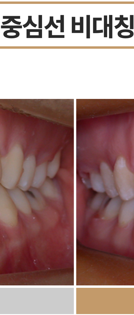 비발치교정 치료, 발치 없이 진행하는 과정 관련 이미지 12