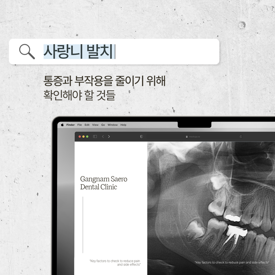 (사랑니발치) 통증과 부작용을 줄이기 위해 확인해야 할 것들 관련 이미지 1